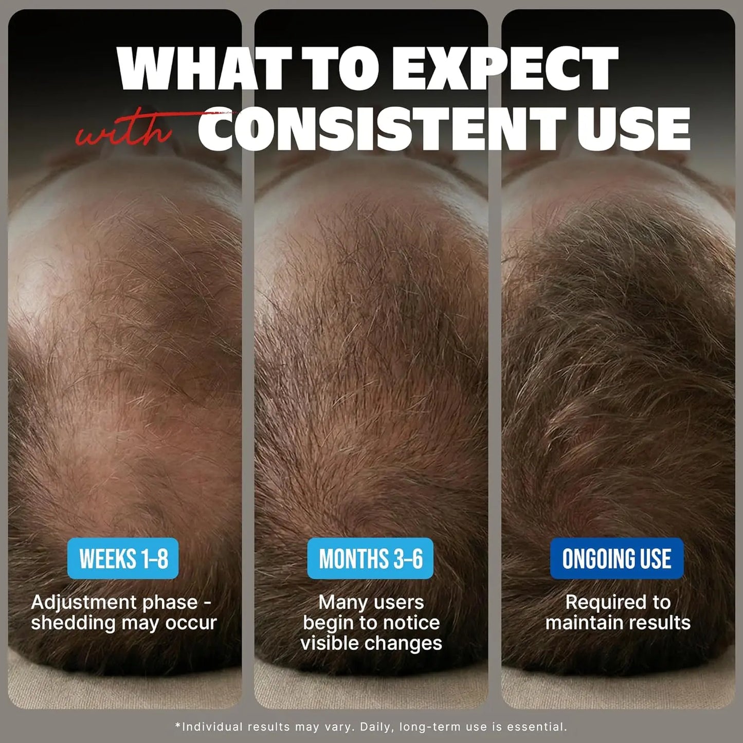 Kirkland Signature Traitement Repousse Cheveux Homme–Minoxidil 5% Solution Topique–Approvisionnement 12 Mois (12 x 60 ml) Kirkland Minoxidil Canada