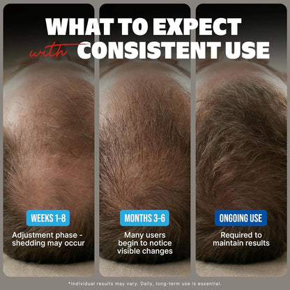 Kirkland Signature Traitement Repousse Cheveux Homme–Minoxidil 5% Solution Topique–Approvisionnement 12 Mois (12 x 60 ml) Kirkland Minoxidil Canada